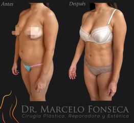 Lipoescultura - Dr. Marcelo Fonseca Canteros