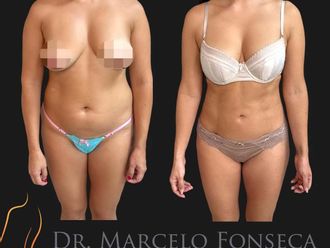 Lipoescultura antes y después - 880769