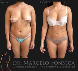Lipoescultura - Dr. Marcelo Fonseca Canteros