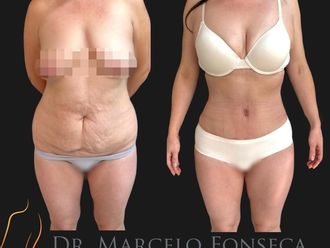 Lipoescultura antes y después - 880770