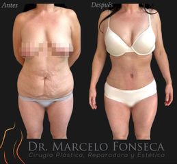 Abdominoplastía más lipoescultura - Dr. Marcelo Fonseca Canteros
