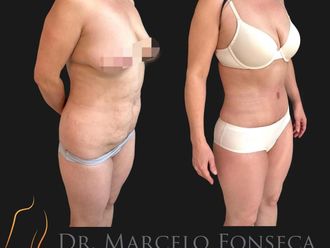 Abdominoplastía antes y después - 880771