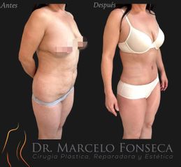 Abdominoplastía más lipoescultura - Dr. Marcelo Fonseca Canteros