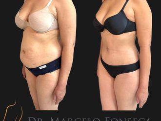 Lipoescultura antes y después - 880774