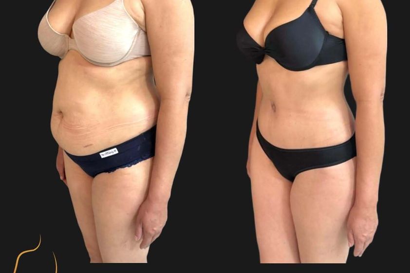 Lipoescultura antes y después - 880774