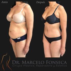 Abdominoplastia asociada a lipoescultura - Dr. Marcelo Fonseca Canteros