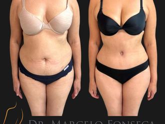 Abdominoplastía antes y después - 880775