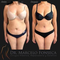 Abdominoplastia asociada a lipoescultura - Dr. Marcelo Fonseca Canteros