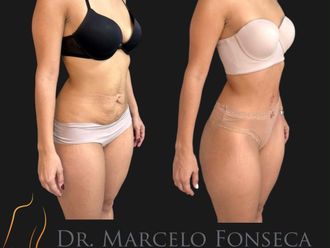 Abdominoplastía antes y después - 880776