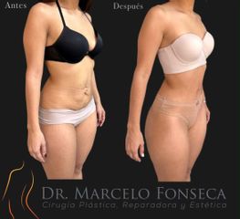 Abdominoplastia - Dr. Marcelo Fonseca Canteros