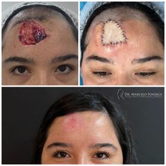 Cirugia reconstructiva - Dr. Marcelo Fonseca Canteros