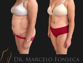 Abdominoplastía antes y después - 880778