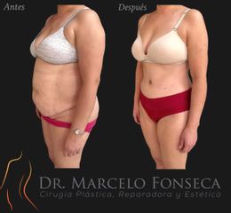 Abdominoplastía - Dr. Marcelo Fonseca Canteros