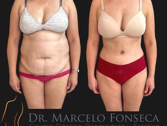 Abdominoplastía antes y después - 880779