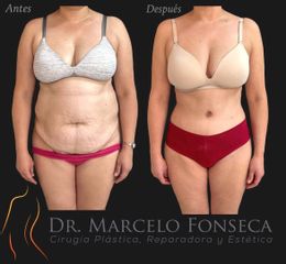 Abdominoplastía - Dr. Marcelo Fonseca Canteros