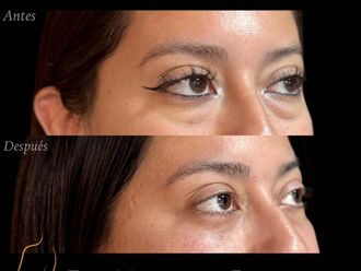 Blefaroplastía antes y después - 880781