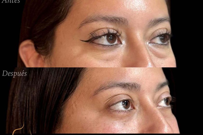 Blefaroplastía antes y después - 880781