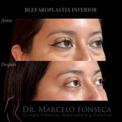 Blefaroplastia - Dr. Marcelo Fonseca Canteros
