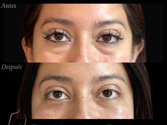 Blefaroplastía antes y después - 880782