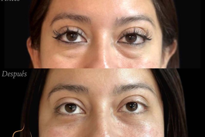 Blefaroplastía antes y después - 880782