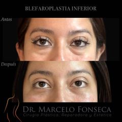 Blefaroplastia - Dr. Marcelo Fonseca Canteros