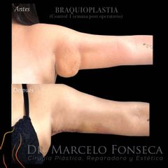 Exceso de piel en los Brazos - Dr. Marcelo Fonseca Canteros