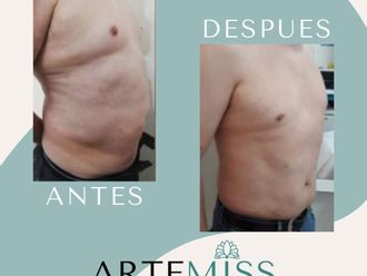 Mesoterapia antes y después - 816894