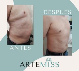 Mesoterapia reductiva - Artemiss