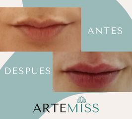 Aumento de labios Acido Hialuronico - Artemiss