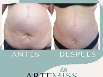 Mesoterapia antes y después - 816897