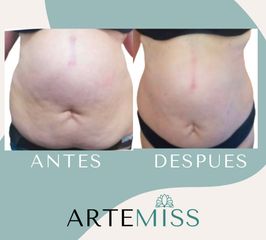 Tratamiento lipilitico - Artemiss