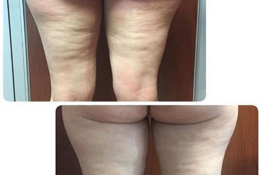 Tratamiento celulitis antes y después - 566509