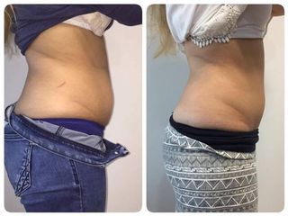 Reductivo BTL Exilis