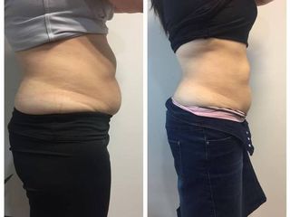 Daniela BTL Exilis Elite