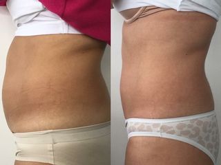 Tratamiento de reducción de tejido graso en abdomen con BTL Exilis Elite 4 sesiones.