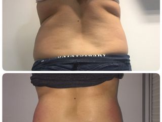 Sólo 3 sesiones de exilis elite de BTL , reducción adiposidad localizada.