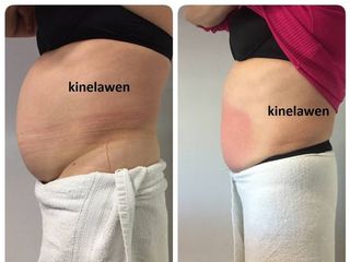 Tratamiento Exilis elite , resultado 3 sesiones de 6 sesiones.