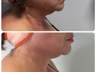 Tratamiento exilis para tensado de piel, disminuyendo flacidez facial y en cuello