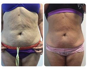 Exilis elite (flacidez corporal)