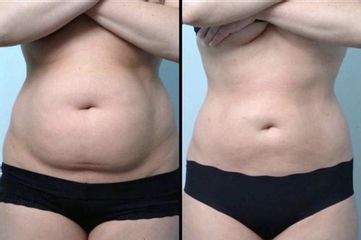 Emsculpt - Kinelawen