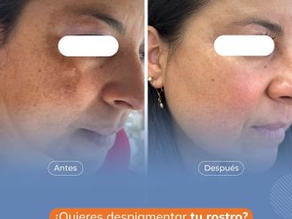 Manchas de la piel antes y después - 860011