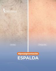 Manchas de la piel - Kinelawen