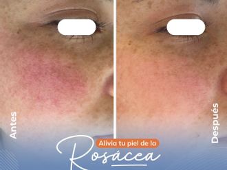 Rosácea antes y después - 860015