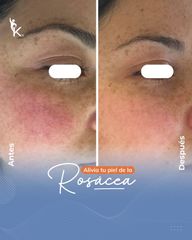 Rosácea - Kinelawen