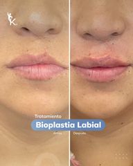 Aumento labios - Kinelawen