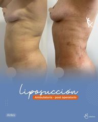 Liposucción - Kinelawen