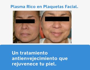 Plasma rico en plaquetas - Dra. Norma ZúñigaDr. Gonzalo Urrutia