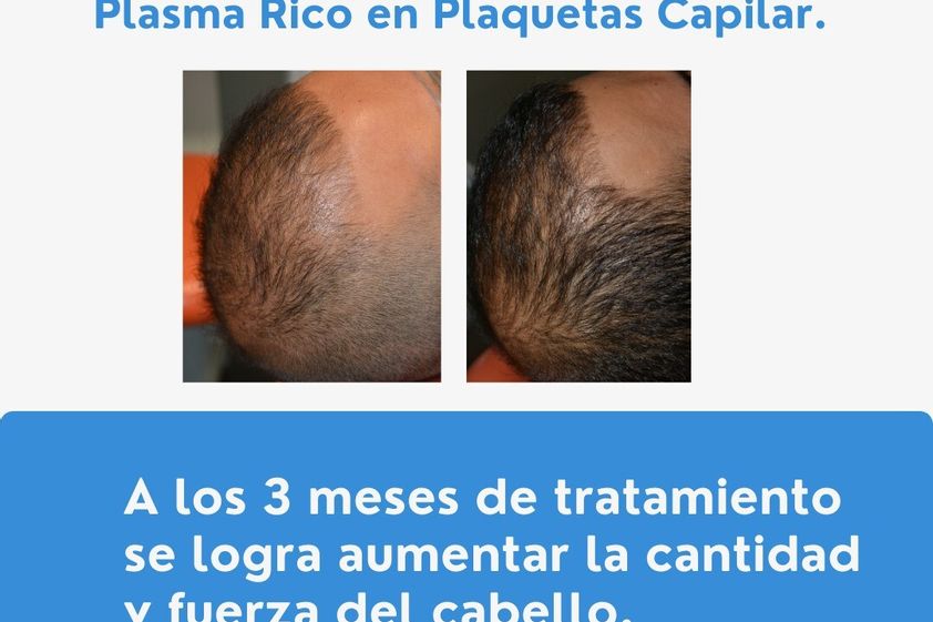 Plasma rico en plaquetas antes y después - 823880