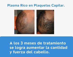 Plasma rico en plaquetas - Dr. Gonzalo Urrutia