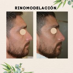 Rinomodelación  - Dr. Gonzalo Urrutia